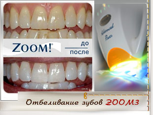 отбеливание зубов ZOOM3