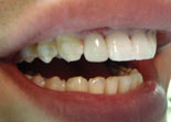 восстановление шиповидных зубов