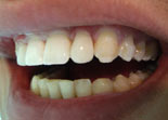 восстановление шиповидных зубов
