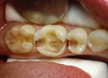 лечение жевательных зубов