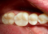 эстетико-функциональное восстановление зубов